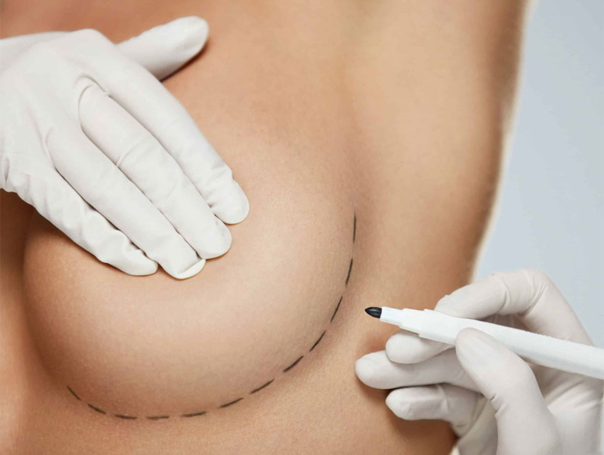 Mamoplastia Redutora – O que acontece durante a cirurgia
